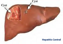 Simple Liver Cysts